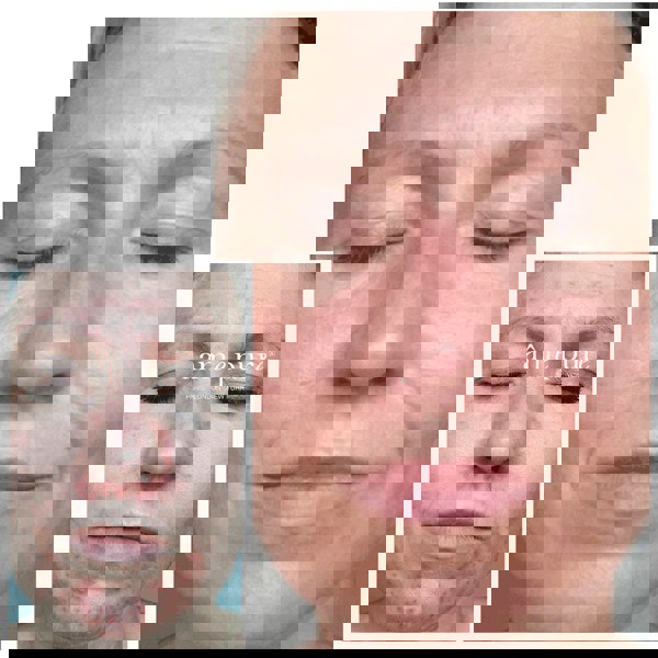 Âme Pure CIT FACE ROLLER PLATINUM - Microneedling Derma Roller Kit