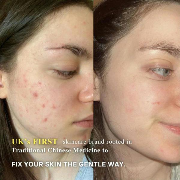 LUWIN Skincare Advanced Clear & Brightening Super Set – Acne & Dark Spot Routine for Clear, Even Skin | LUWIN