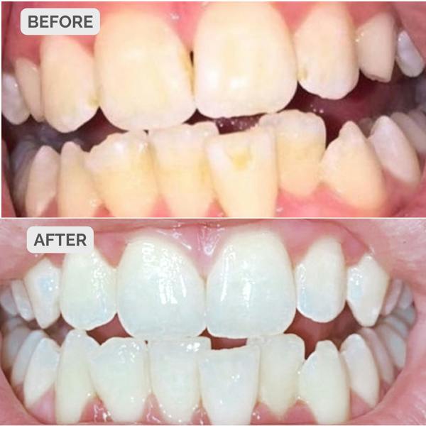 Smile Science Harley Street Professional Teeth Whitening Kit