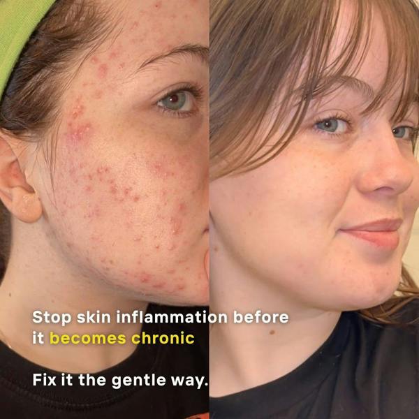 LUWIN Skincare Ultimate Repair & Clear Face Cream – Calming Acne Cream for Acne-Prone Skin | LUWIN