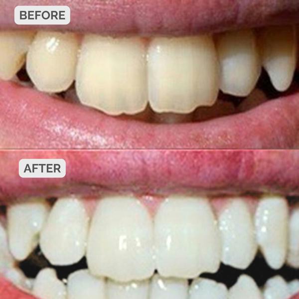 Smile Science Harley Street Teeth Whitening Strips 7 Day