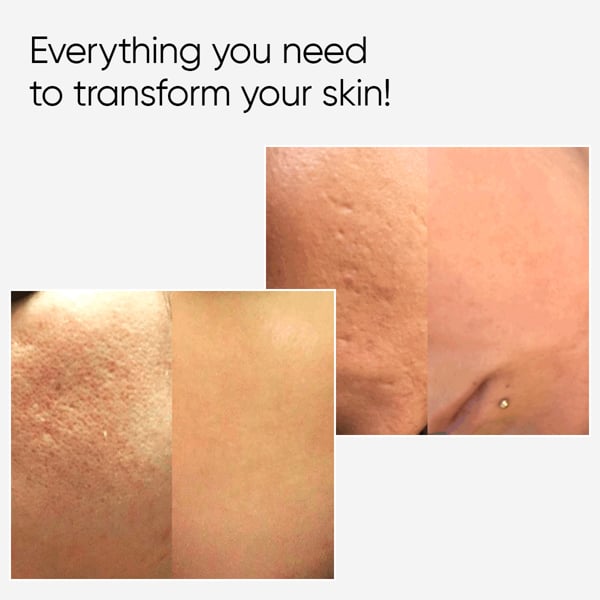 Âme Pure CIT FACE ROLLER 0.5 mm - Microneedling Derma Roller For Face