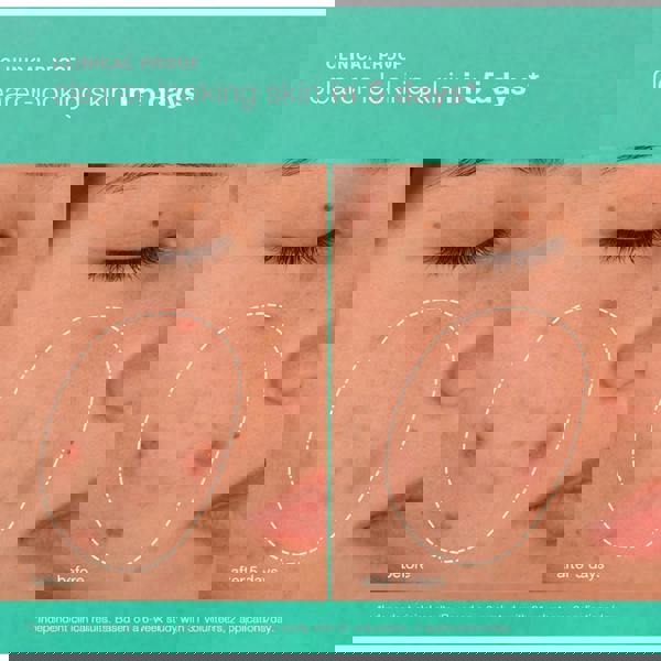 Dermalogica Breakout Biotic Moisturiser