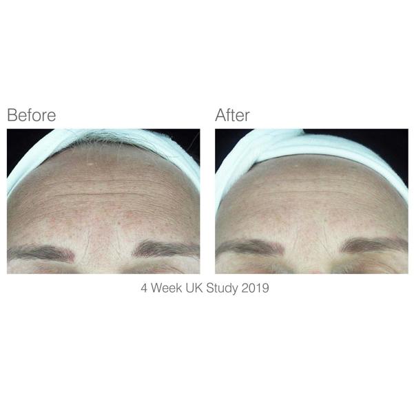 before and after 4 week study of forehead area with visibly reduced wrinkles after using facelite beauty boosting LED face mask