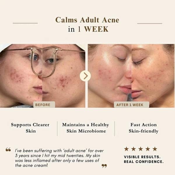 LUWIN Skincare Advanced Calming & Clear Duo – Acne Cream & Calming Mist Set for Clear Skin | LUWIN