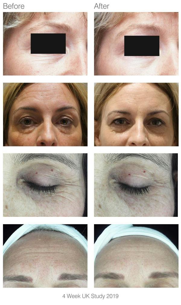side by side before and after studies from people who have used facelite beauty boosting LED face mask with now visibly reduced wrinkles  