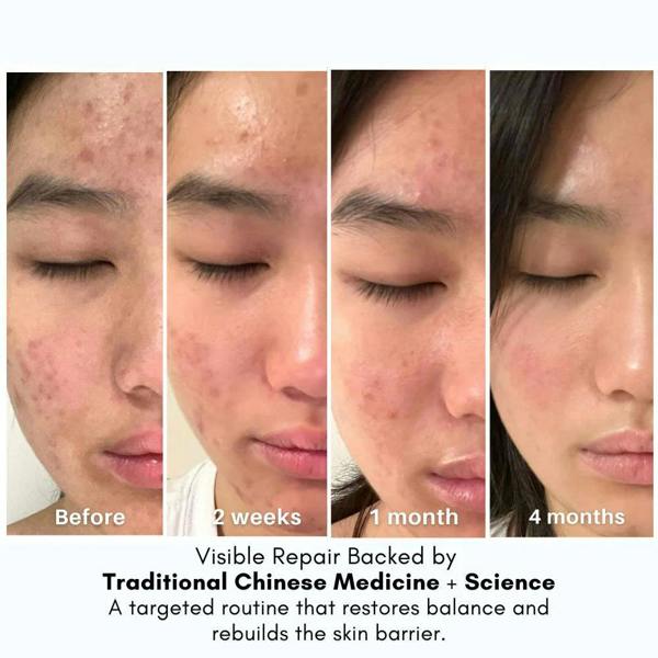 LUWIN Skincare Advanced Calming & Clear Duo – Acne Cream & Calming Mist Set for Clear Skin | LUWIN