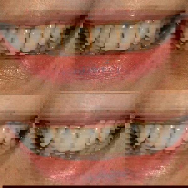 Smile Science Harley Street Teeth Whitening Kit