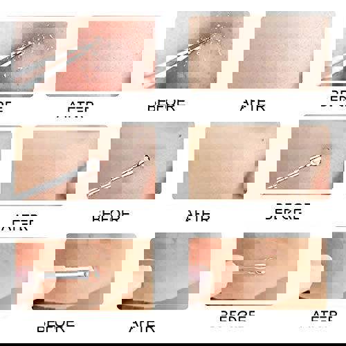 KAV Comedone extractor | Blackhead Remover Tool | Acne Comedone Pimple Blemish Extractor | Stainless Steel Remover Tool Kit Set with Box Skin Care