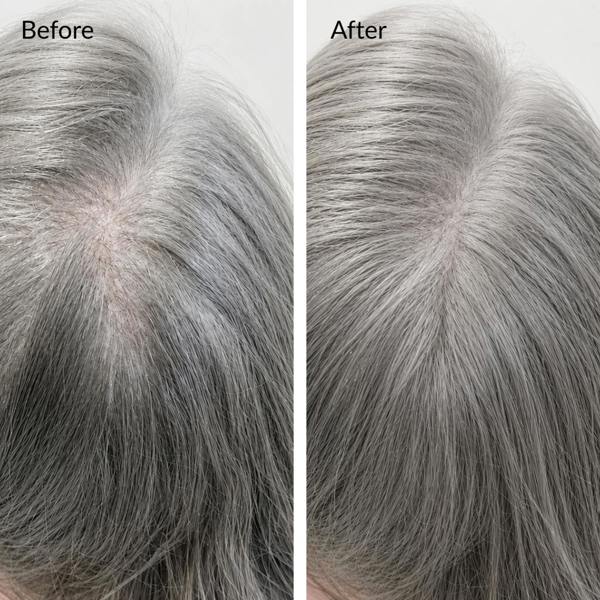 Before and after comparison of gray hair treatment on a person's head. Before and after hair growth transformation using rosemary hair oil
