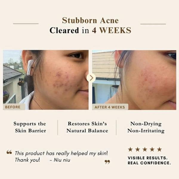 LUWIN Skincare Ultimate Repair & Clear Face Cream – Calming Acne Cream for Acne-Prone Skin | LUWIN