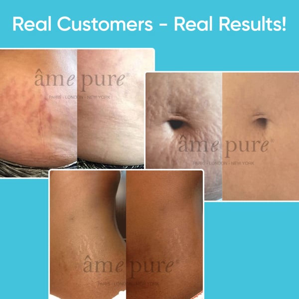 Âme Pure BODY BASIC | STRETCH MARKS – Microneedling Derma Roller Kit For Cellulite & Stretch Marks