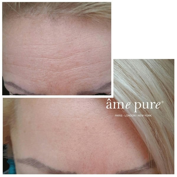 Âme Pure WRINKLERASER BASIC - Microneedling Derma Roller Kit