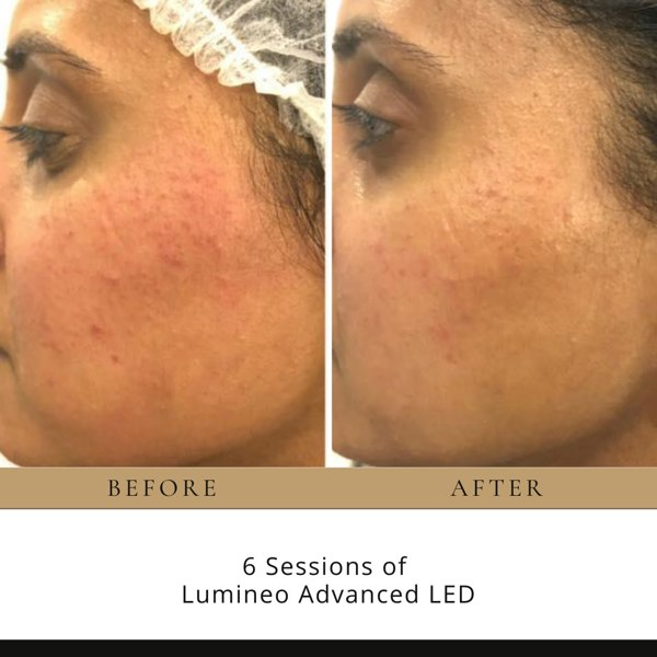 Neo Elegance UK Lumineo Professional LED Light Therapy Panel