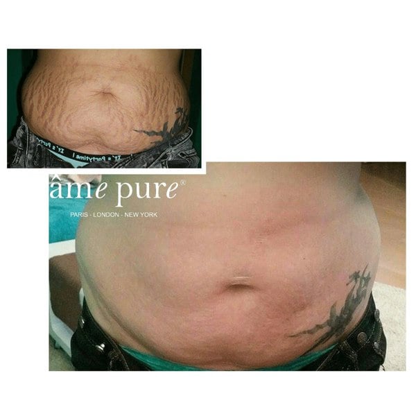 Âme Pure BODY BASIC | STRETCH MARKS – Microneedling Derma Roller Kit For Cellulite & Stretch Marks