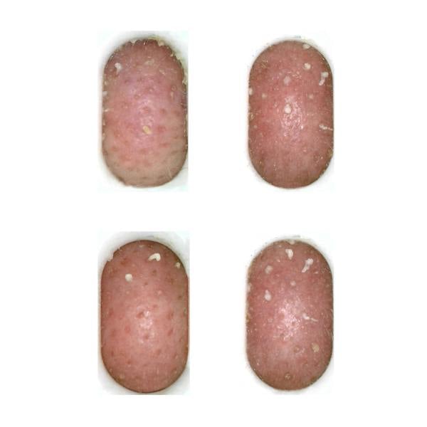 camera feed images of sebum plugs blackheads and spots being gently sucked out using the large treatment head on the pore perfection