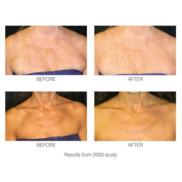 2/2 - 2020 Study - Before and after images showing how the decoLITE LED light treatment soft-fit mask has improved the look of wrinkles and pigmentation.