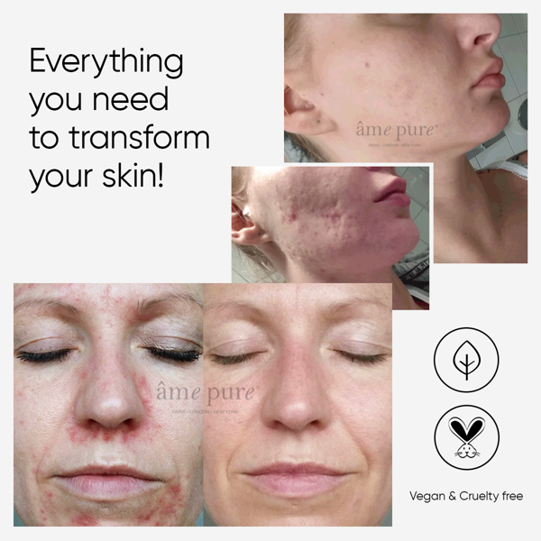 Âme Pure CIT FACE ROLLER PLATINUM - Microneedling Derma Roller Kit