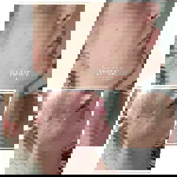 Âme Pure CIT FACE ROLLER PLATINUM - Microneedling Derma Roller Kit