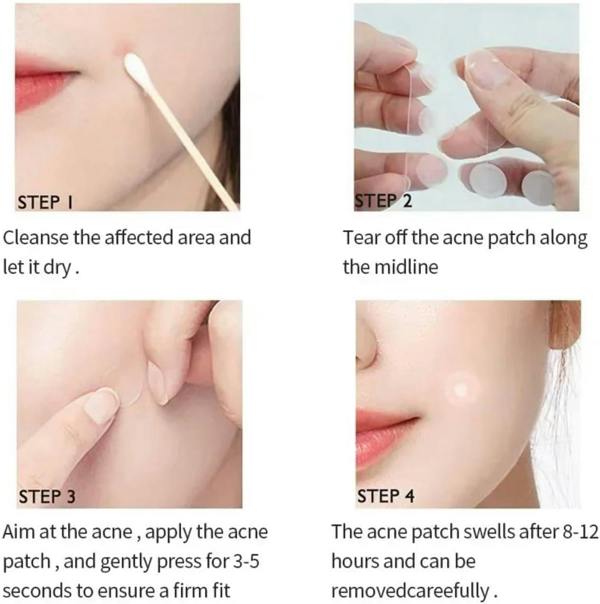 Dyzi 72 Invisible Acne Patch Pimple Stickers For Zits & Blemishes