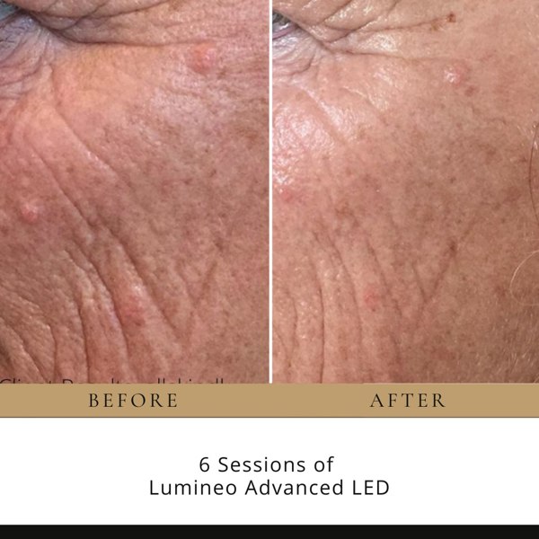 Neo Elegance UK Lumineo Professional LED Light Therapy Panel