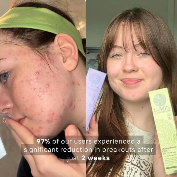 LUWIN Skincare Advanced Calming & Clear Duo – Acne Cream & Calming Mist Set for Clear Skin | LUWIN