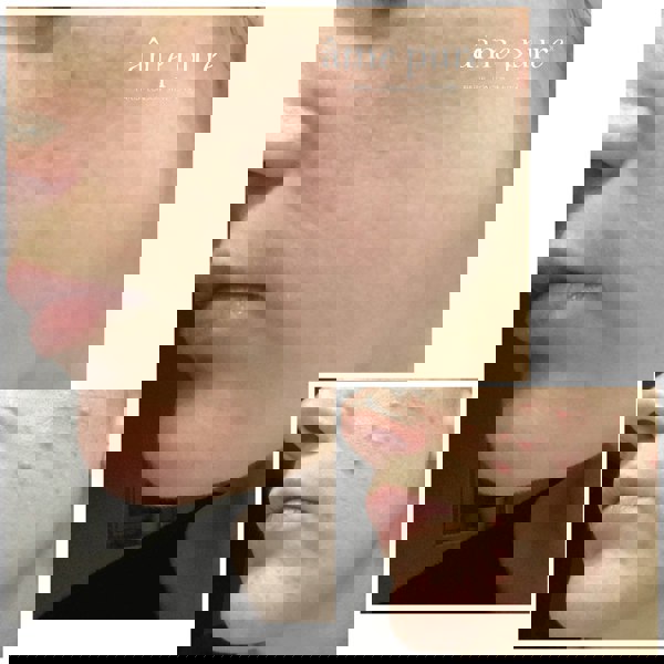 Âme Pure CIT FACE ROLLER PLATINUM - Microneedling Derma Roller Kit