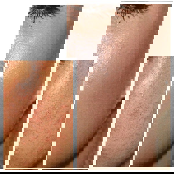 Âme Pure CIT FACE ROLLER PLATINUM - Microneedling Derma Roller Kit