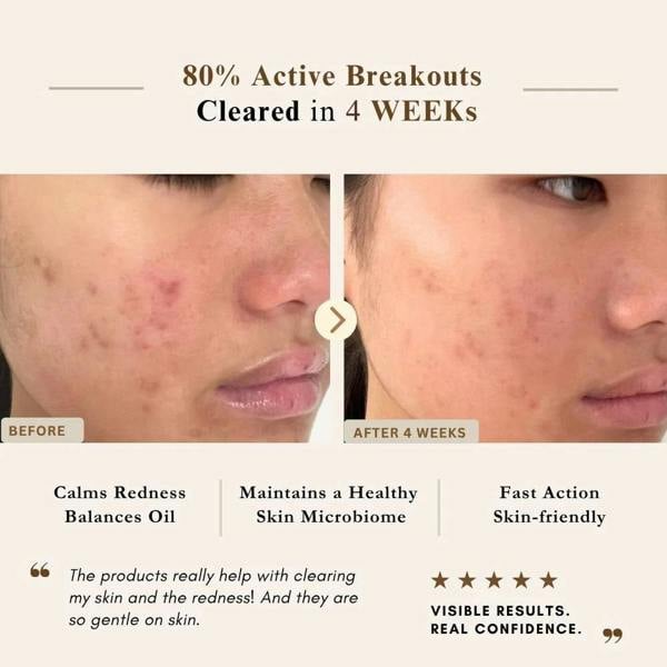 LUWIN Skincare Ultimate Repair & Clear Face Cream – Calming Acne Cream for Acne-Prone Skin | LUWIN
