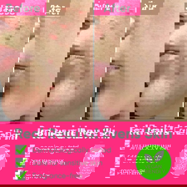 ame pure peels so good, chemical peeling, chemical peel,  aha, bha, fruit a cid, smooth skin peelilng, enyzme scrub, oily skin, acne removal