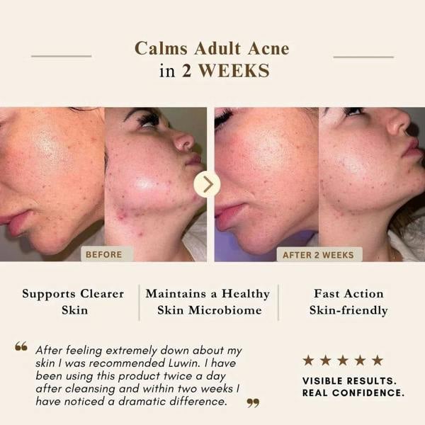 LUWIN Skincare Ultimate Repair & Clear Face Cream – Calming Acne Cream for Acne-Prone Skin | LUWIN