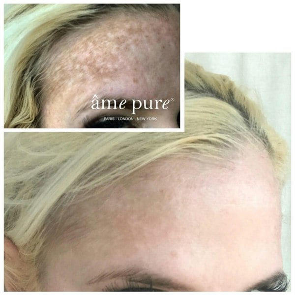 Âme Pure WRINKLERASER BASIC - Microneedling Derma Roller Kit