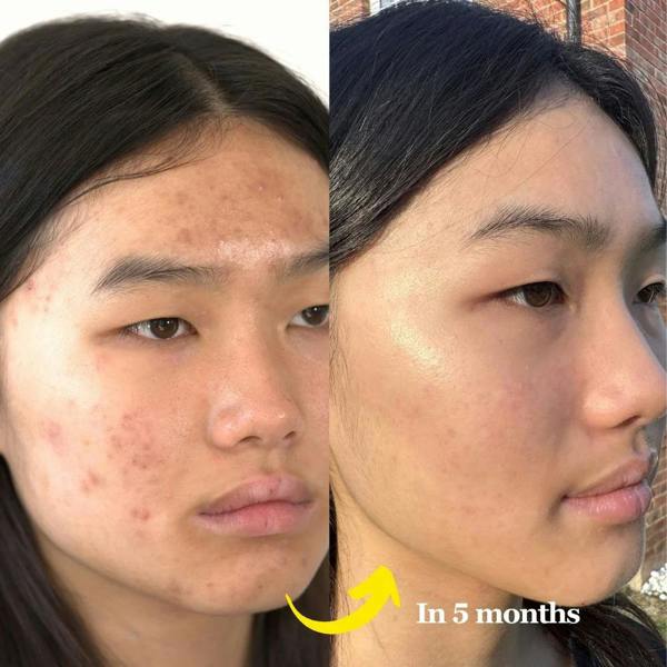 LUWIN Skincare Advanced Clear & Brightening Super Set – Acne & Dark Spot Routine for Clear, Even Skin | LUWIN